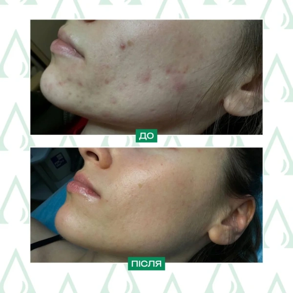Карбокситерапія CO2 для обличчя та зони декольте 7 процедур / Lamic Cosmetici купить
