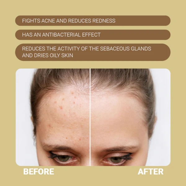 ПРОТИЗАПАЛЮВАЛЬНА СИВОРОТКА / ANTI-ACNE SERUM / Sanmarine купить