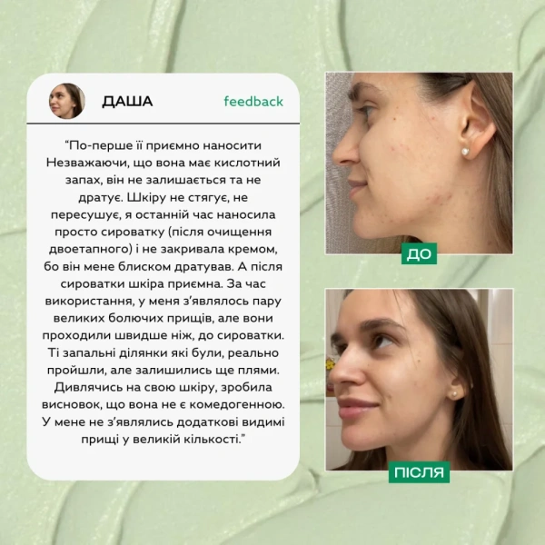 Сыворотка для лица с проявлениями акне / "Siero per il viso con sintomi di acne" / Lamic Cosmetici купить