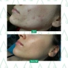 Карбокситерапия CO2 для лица и зоны декольте 7 процедур / Lamic Cosmetici купить