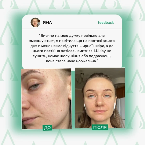 Сироватка для обличчя з проявами акне / "Siero per il viso con sintomi di acne" / Lamic Cosmetici купить
