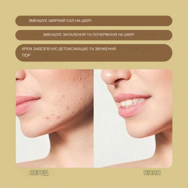Себорегулирующий крем / ANTI-ACNE CREAM / Sanmarine купить