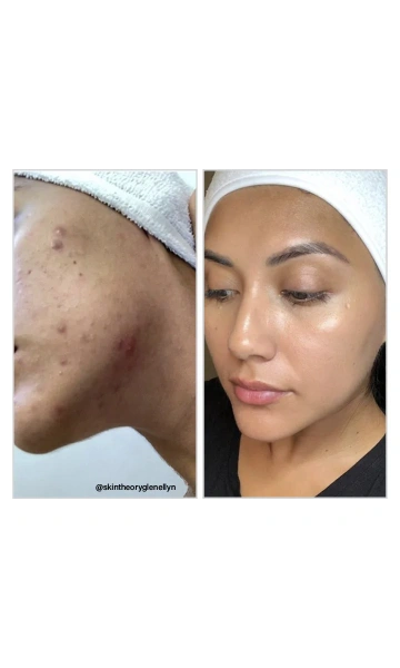 Сироватка з 8% мигдальної кислоти / 8% Mandelic Acid 3-in-1 Serum / Vivant купить