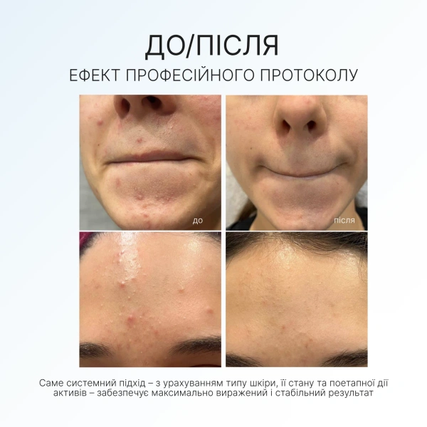 Сыворотка с азелоглицином и салициловой кислотой / Serum with azeloglycine and retinol / AG Skin купить